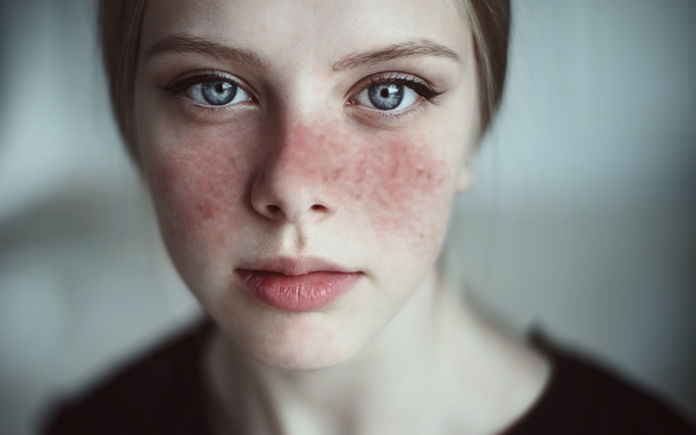 Lupus